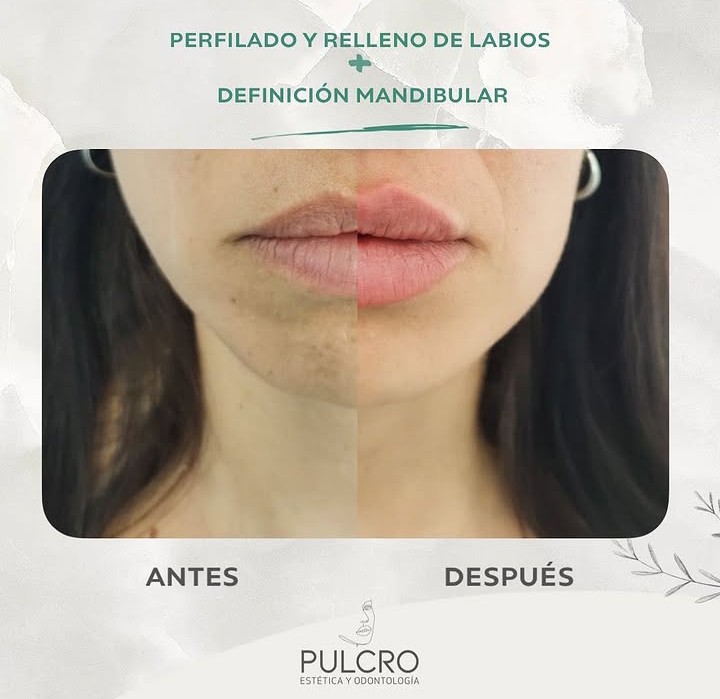 Caso real — Perfilado de labios + Mandíbula