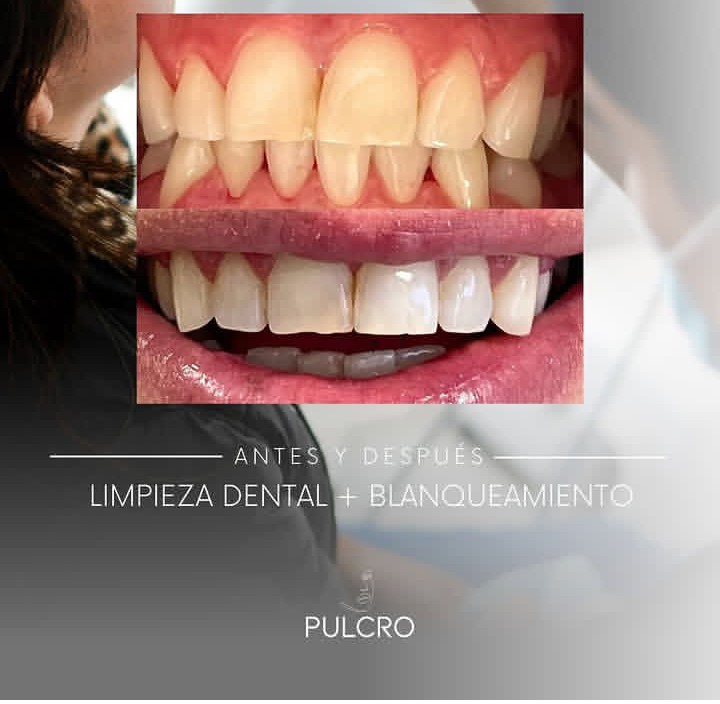 Caso real — Limpieza + Blanqueamiento