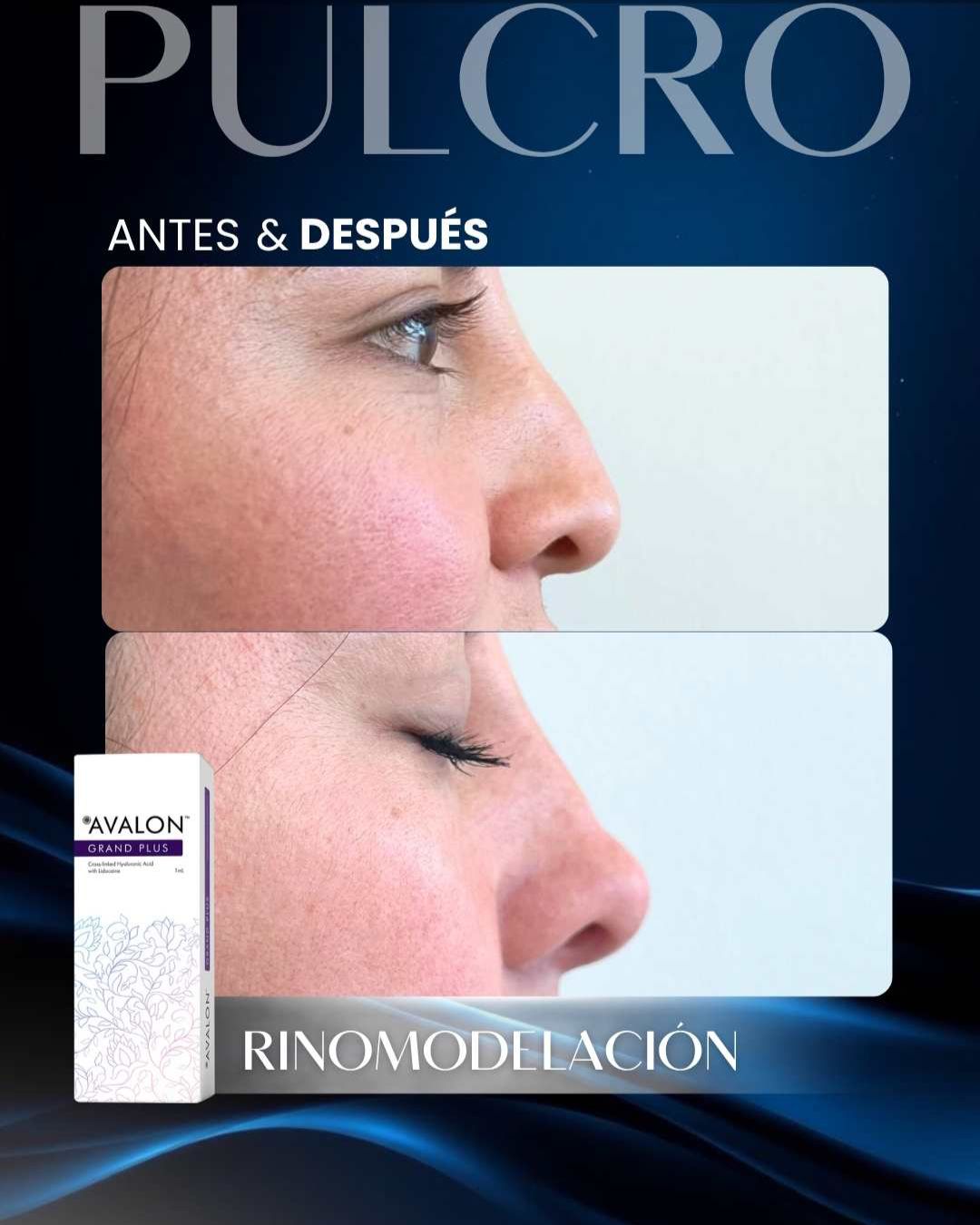 Caso real — Rinomodelación