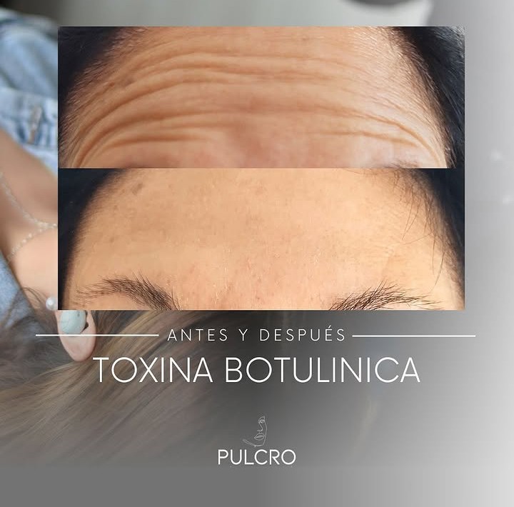 Caso real — Toxina botulínica